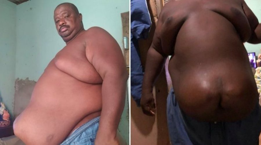 [Morador de Nordeste de Amaralina aguarda há dois anos por uma cirurgia de hérnia umbilical e pede ajuda ]