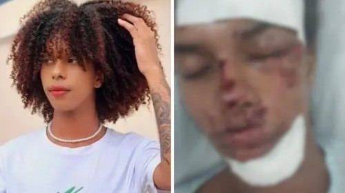 [Influenciador que teve rosto desfigurado é transferido de hospital]