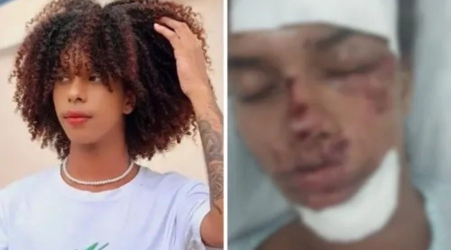 [Influenciador que teve rosto desfigurado é transferido de hospital]